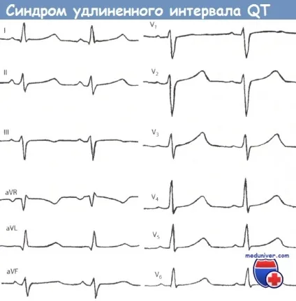 Синдром подовженого інтервалу qt на ЕКГ (подовженого) Синдром подовженого інтервалу qt на ЕКГ