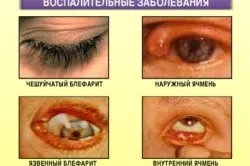 Сльозяться очі причини та лікування (причини) Сльозяться очі причини та лікування