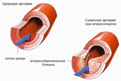 Стеноз хребетної артерії причини, симптоми, лікування (стеноз) Стеноз хребетної артерії причини, симптоми, лікування