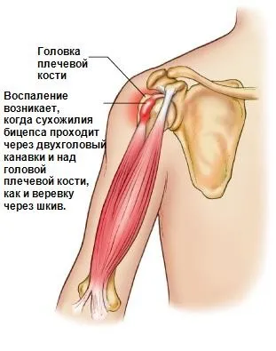 Тендиніт довгої головки біцепса, як лікувати (головки) Тендиніт довгої головки біцепса, як лікувати