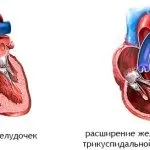 Трикуспидальная регургітація причини, симптоми і лікування (регургітація) Трикуспидальная регургітація причини, симптоми і лікування