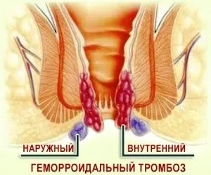 Тромбоз гемороїдального вузла - причини, симптоми і лікування (симптоми) Тромбоз гемороїдального вузла - причини, симптоми і лікування