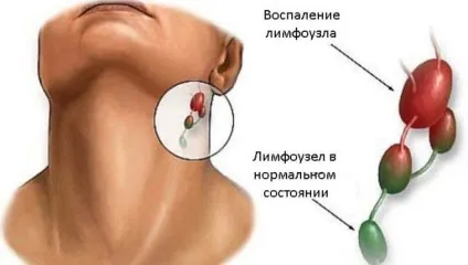 Видалення щитовидної залози - наслідки у жінок операція, дієта (операція) Видалення щитовидної залози - наслідки у жінок операція, дієта