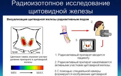 Видалення щитовидної залози - наслідки у жінок операція, дієта (видалення) Видалення щитовидної залози - наслідки у жінок операція, дієта