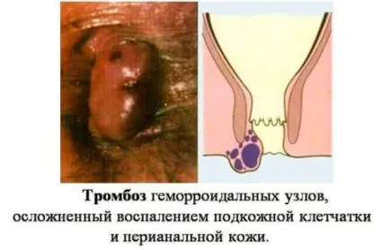 Тромбоз гемороїдального вузла - причини, симптоми і лікування (симптоми) Тромбоз гемороїдального вузла - причини, симптоми і лікування