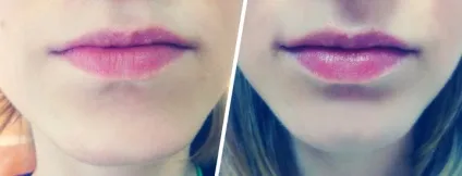Збільшення губ гіалуронової кислотою (гіалуронової) Збільшення губ гіалуронової кислотою
