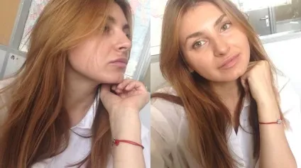 Збільшення губ в москві, відгуки, фото до і після, процедура збільшення, журнал cosmopolitan (процедура) Збільшення губ в москві, відгуки, фото до і після, процедура збільшення, журнал cosmopolitan