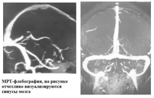 Венозна енцефалопатія симптоми, діагностика, лікування (симптоми) Венозна енцефалопатія симптоми, діагностика, лікування