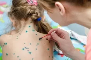 Вітряна віспа у дітей фото, симптоми і лікування, щеплення (віспа) Вітряна віспа у дітей фото, симптоми і лікування, щеплення