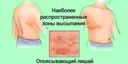 Вітряна віспа у дітей фото, симптоми і лікування, щеплення (вітряна віспа у дітей) Вітряна віспа у дітей фото, симптоми і лікування, щеплення