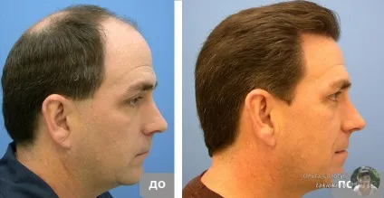 Vichy dercos neogenic - відгуки чоловіків і жінок (vichy) Vichy dercos neogenic - відгуки чоловіків і жінок