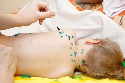 Вітрянка в легкій формі у дітей симптоми і лікування (формі) Вітрянка в легкій формі у дітей симптоми і лікування