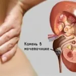 Види каменів в нирках