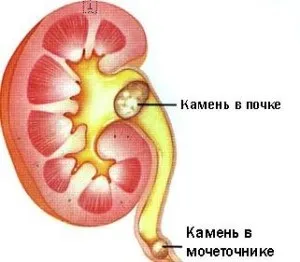 Види каменів в нирках