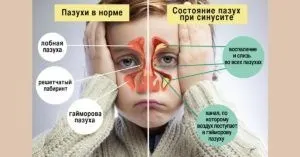 Запалення пазух носа лікування і симптоми (запалення) Запалення пазух носа лікування і симптоми