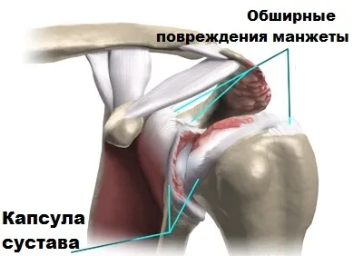 Обертальна (ротаторна) манжета плечового суглоба (суглоба) Обертальна (ротаторна) манжета плечового суглоба