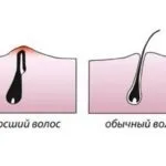 Врослі волосся на ногах - як вилікувати проблему (врослі волосся ногах) Врослі волосся на ногах - як вилікувати проблему