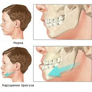 Хрускіт в вусі при ковтанні скрип, тріск і шум у вухах - його причини і як від цього позбавитися (причини) Хрускіт в вусі при ковтанні скрип, тріск і шум у вухах - його причини і як від цього позбавитися
