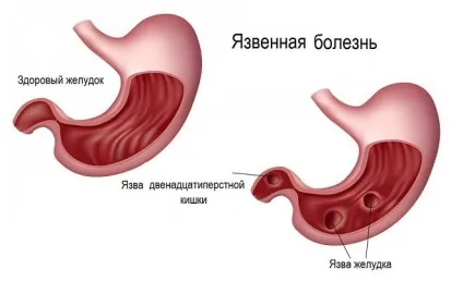 Виразкова кровотеча виразка, при виразці, симптоми, дванадцятипалої кишки (кровотеча) Виразкова кровотеча виразка, при виразці, симптоми, дванадцятипалої кишки