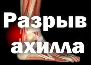 Розрив ахіллового сухожилля, реабілітація після операції, терміни відновлення, лікування (розрив) Розрив ахіллового сухожилля, реабілітація після операції, терміни відновлення, лікування