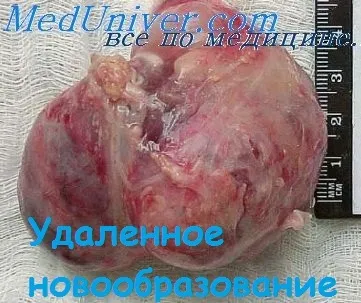 Розміри і будова ліпом середостіння