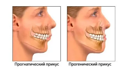 Різновиди зубних брекет-систем які бувають брекети на зуби