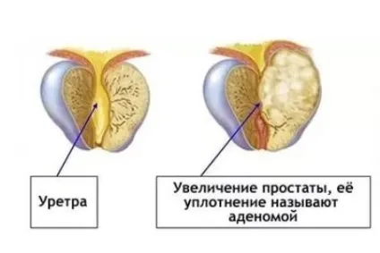 Розміри передміхурової залози норма обсягу по узі (норма) Розміри передміхурової залози норма обсягу по узі