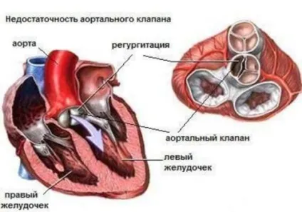 Реактивний артрит у дітей причини, симптоми і лікування (причини) Реактивний артрит у дітей причини, симптоми і лікування