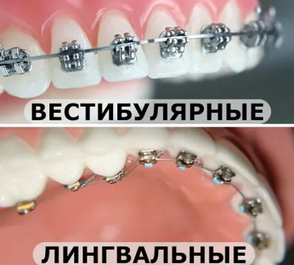 Різновиди зубних брекет-систем які бувають брекети на зуби