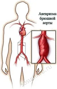 Аневризма черевної аорти симптоми, лікування
