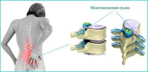 Апарати Денас успішно лікують міжхребцеву грижу (лікують) Апарати Денас успішно лікують міжхребцеву грижу