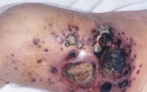 Ангіосаркома види, причини, симптоми, діагностика, лікування та прогноз