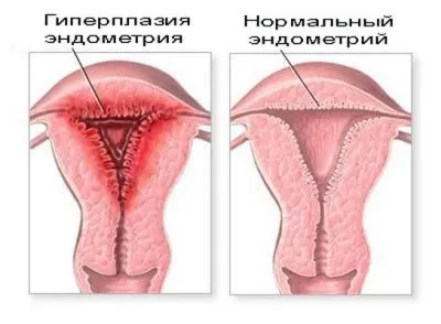 Ановуляторний цикл що це таке, причини і лікування, коли чекати місячних (таке) Ановуляторний цикл що це таке, причини і лікування, коли чекати місячних