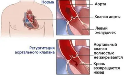 Аортальна недостатність причини, симптоми і лікування (недостатність) Аортальна недостатність причини, симптоми і лікування