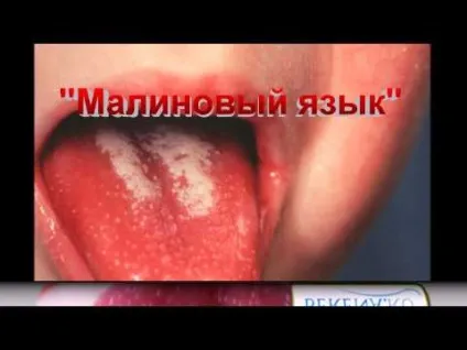 Антибіотики при скарлатині у дітей що приймати і як правильно (правильно) Антибіотики при скарлатині у дітей що приймати і як правильно