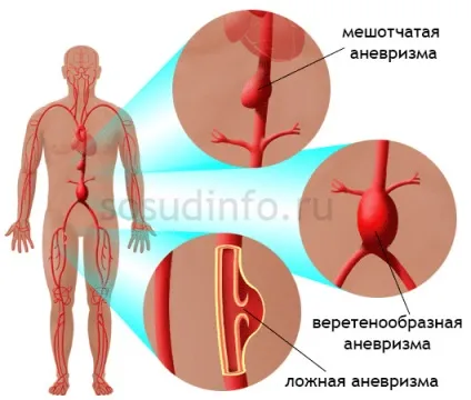 Аневризма черевної аорти симптоми, лікування