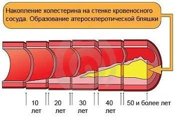 Швидка чистка судин в домашніх умовах