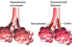 Чим небезпечний хронічний бронхіт