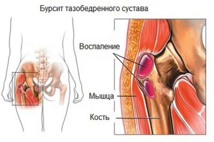 Бурсит тазостегнового суглоба причини, симптоми, лікування (тазостегнового) Бурсит тазостегнового суглоба причини, симптоми, лікування