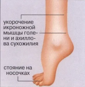 Що таке ахіллопластіка