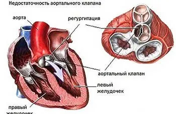 Що стоїть за діагнозом аортальна недостатність (можуть включати себе) Що стоїть за діагнозом аортальна недостатність