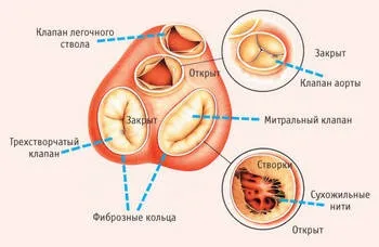 Що стоїть за діагнозом аортальна недостатність (можуть включати себе) Що стоїть за діагнозом аортальна недостатність