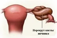 Що таке перекрут кісти яєчника, причини і симптоми (яєчника) Що таке перекрут кісти яєчника, причини і симптоми
