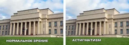 Змішати астигматизм обох очей у дітей лікування (очей) Змішати астигматизм обох очей у дітей лікування