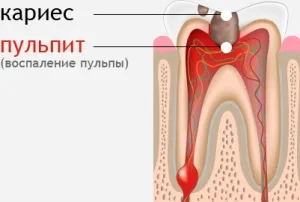 Дірка в зубі причини і наслідки! Бути може кращий сайт про лікування зубів (зубі) Дірка в зубі причини і наслідки! Бути може кращий сайт про лікування зубів