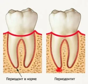Дірка в зубі причини і наслідки! Бути може кращий сайт про лікування зубів (зубі) Дірка в зубі причини і наслідки! Бути може кращий сайт про лікування зубів