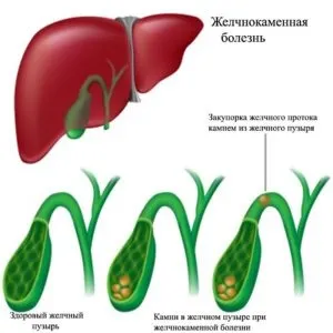 Дискінезія жовчовивідних шляхів у дітей причини, симптоми і лікування (дискінезія) Дискінезія жовчовивідних шляхів у дітей причини, симптоми і лікування