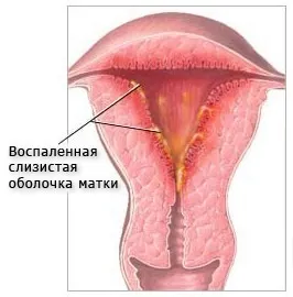 Ендометрит симптоми і лікування народними засобами (народними) Ендометрит симптоми і лікування народними засобами