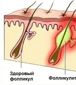 Фолікуліт (запалення волосяної цибулини) причини і лікування (запалення) Фолікуліт (запалення волосяної цибулини) причини і лікування