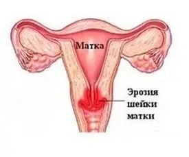 Ерозія шийки матки - причини, симптоми, лікування (причини) Ерозія шийки матки - причини, симптоми, лікування